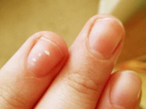 Obłączek i paznokcie