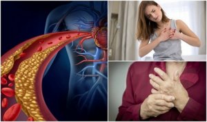 Wysoki cholesterol - sprawdź, czy masz tych 10 objawów
