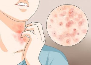 3 domowe lekarstwa na świerzb