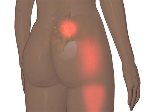 ból i dysfunkcja stawu krzyżowo-biodrowego u kobiety
