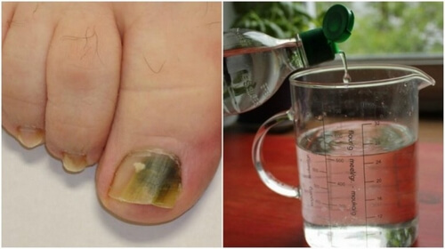 Grzybica paznokci – remedium na bazie alkoholu