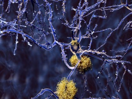Neurony - demencja i różne rodzaje stwardnienia rozsianego