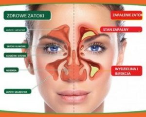Zapalenie zatok - skąd się bierze i jak się objawia?