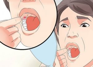 Ząb mądrości - sposoby na opuchliznę po usunięciu