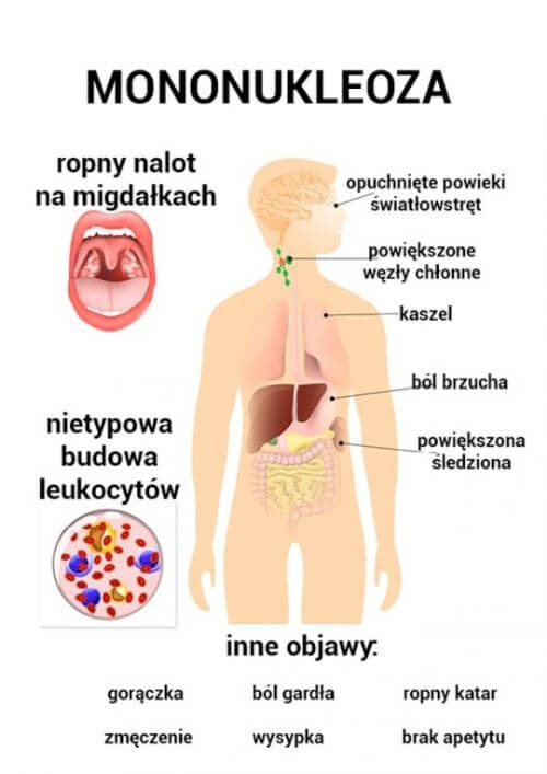 Mononukleoza
