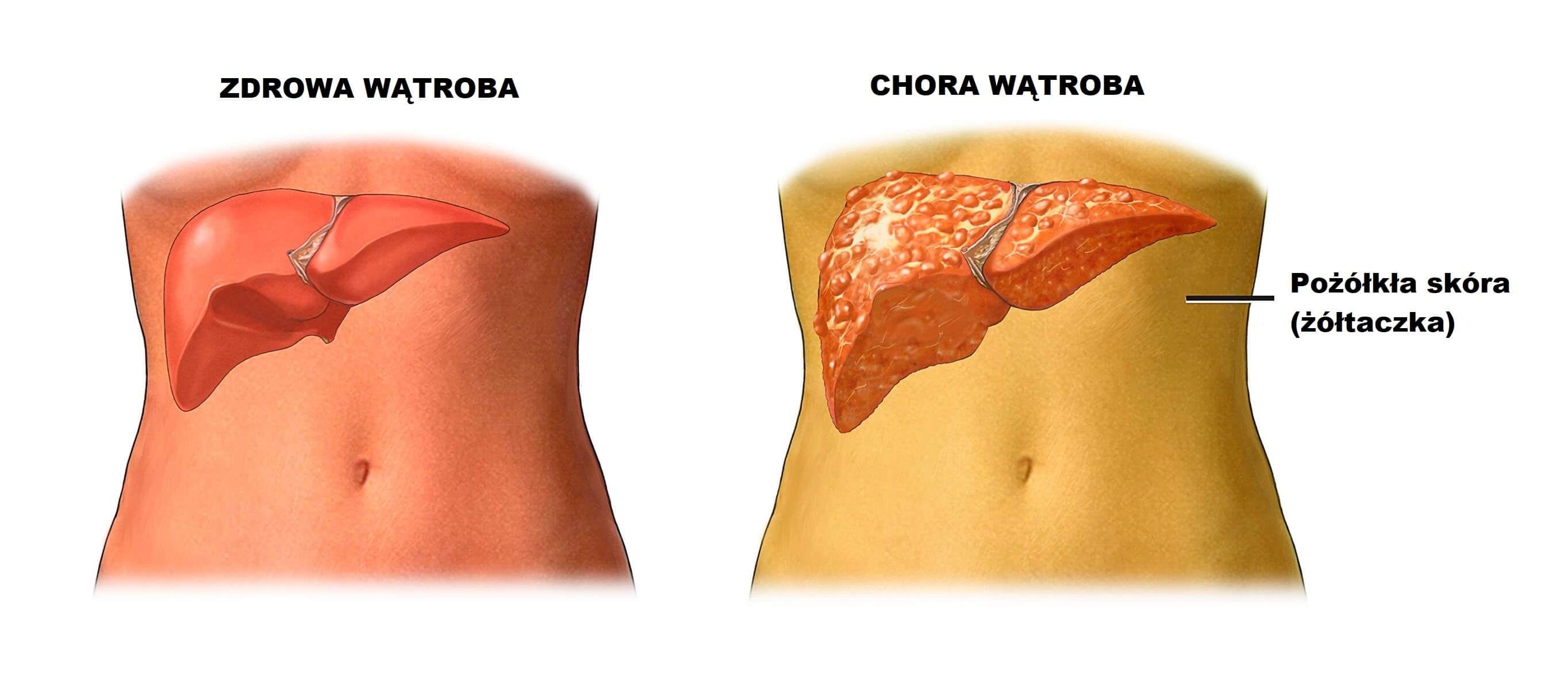 zapalenie wątroby a zdrowa wątroba