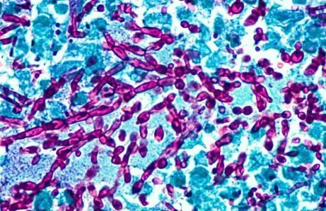 Bakterie a infekcje intymne