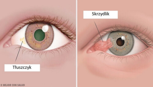 Guzy rogówki oka: tłuszczyk i skrzydlik