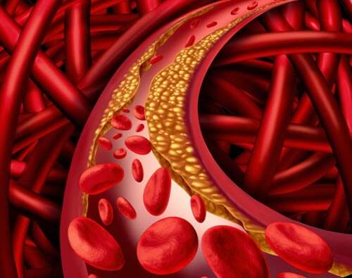 zły cholesterol w tętnicach