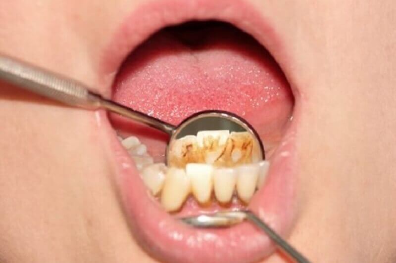 Kamień nazębny badanie u dentysty