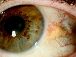 Oko tłuszczyk Guzy rogówki oka 