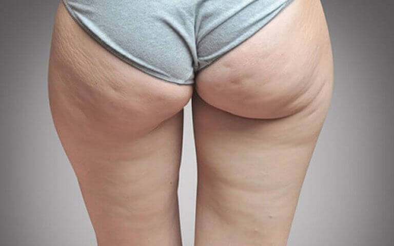 cellulitis zatrzymanie wody