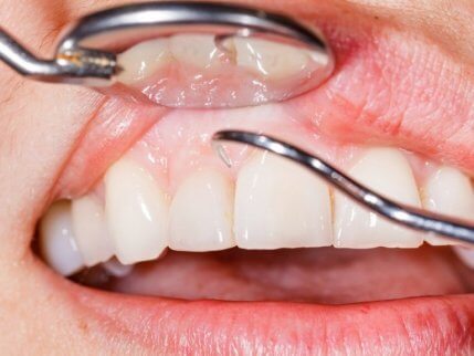Przegląd zębów i dziąseł