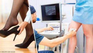 Żylaki - zapomnij o nich dzięki tym naturalnym metodom