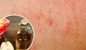 Grzybica skóry - zwalcz ją tymi 5 naturalnymi sposobami