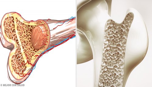 Osteoporoza - przekrój kości