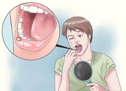 Owrzodzenie jamy ustnej – 8 naturalnych rozwiązań