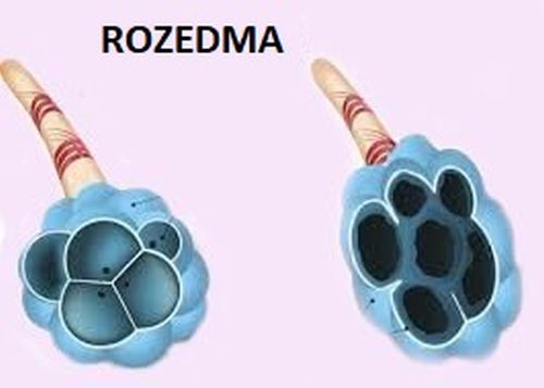 Rozedma puc