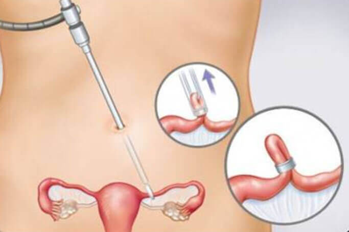 Sterylizacja