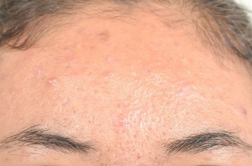 Łojotokowe zapalenie skóry – naturalne leczenie