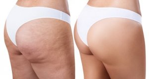 Cellulit – domowe sposoby na skórkę pomarańczową