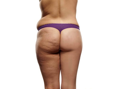 Dieta antycellulitowa – najważniejsze wskazówki