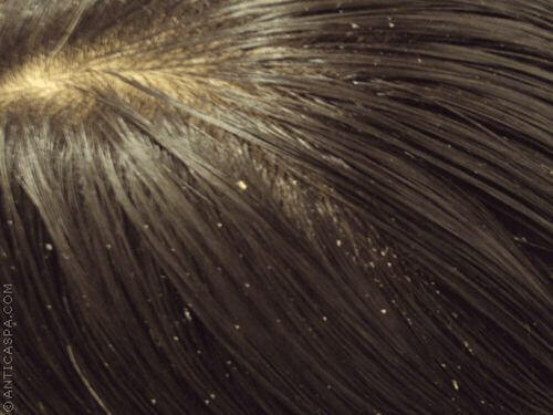 Łupież na włosach