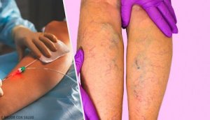Leczenie żylaków - przedstawiamy różne alternatywy