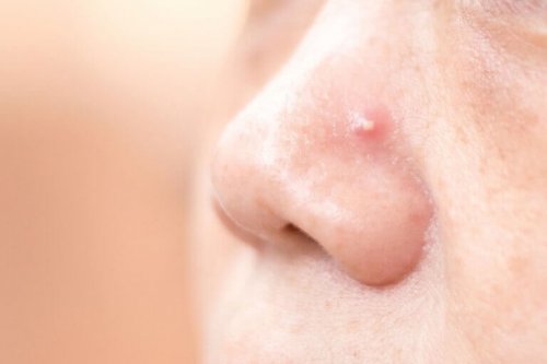 Pryszcze na nosie – pozbądź się ich dzięki tym 4 domowej roboty specyfikom