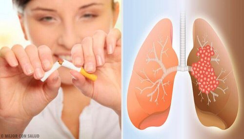 Rak płuc – Główne przyczyny i diagnostyka