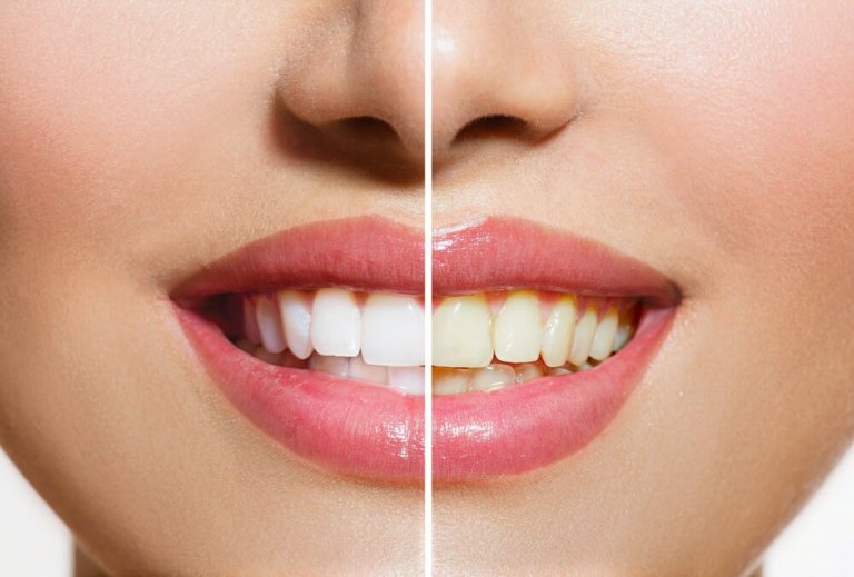 Biały uśmiech – domowe metody wybielania zębów