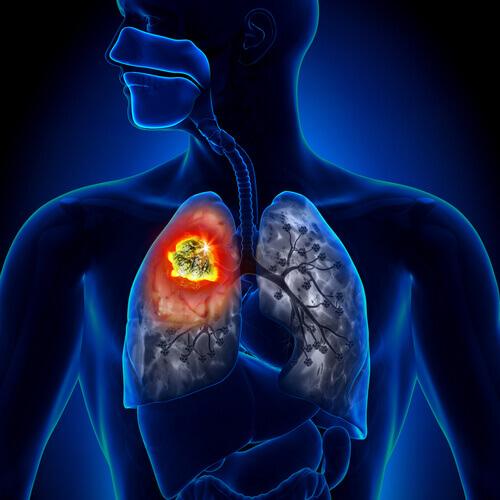 Typy raka płuc