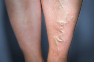 Naturalne sposoby na żylaki – Wypróbuj je!