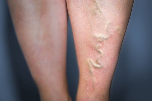Naturalne sposoby na żylaki – Wypróbuj je!