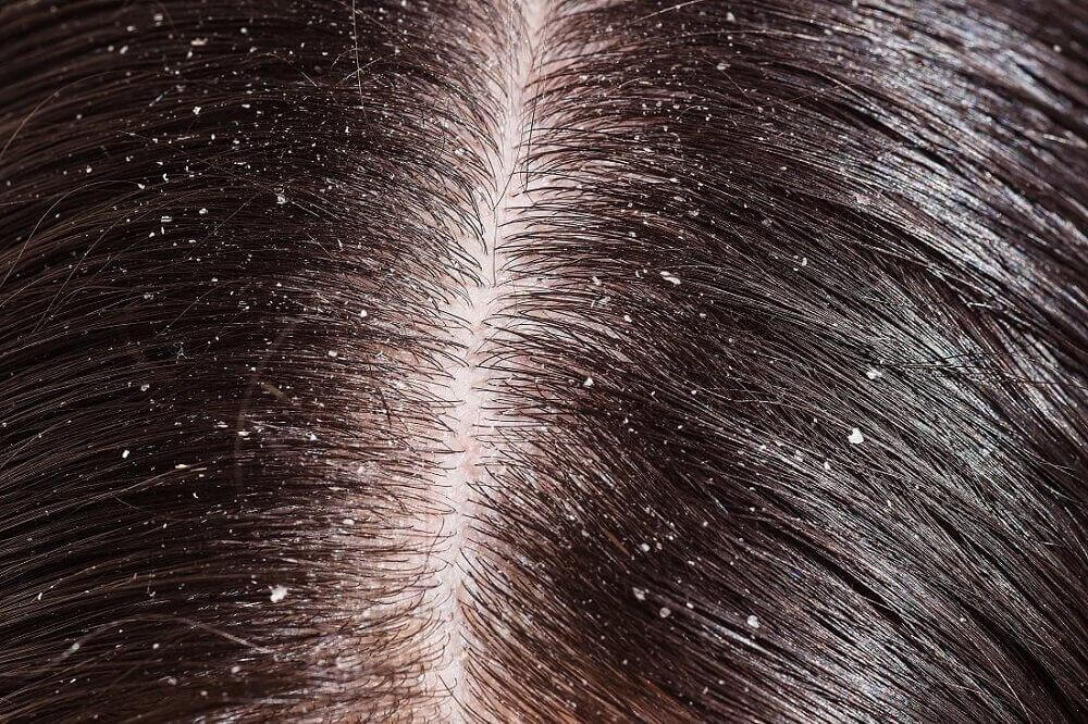Łupież we włosach