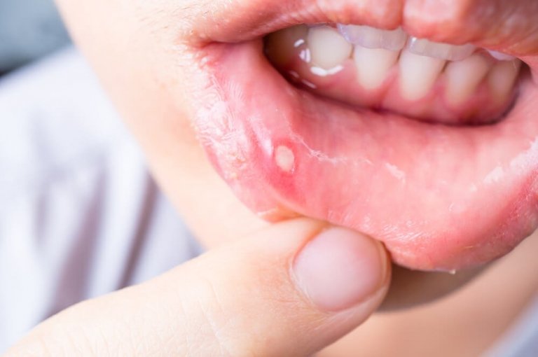 Owrzodzenia jamy ustnej - 7 sposobów leczenia
