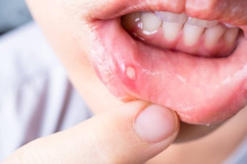 Owrzodzenia jamy ustnej – 7 sposobów leczenia