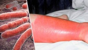 Róża - co to za choroba i jak sobie z nią radzić?