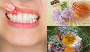 Krwawienie dziąseł – wylecz je naturalnymi remediami