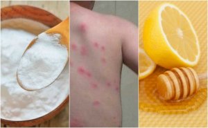 Ugryzienia pcheł – 5 domowych sposobów leczniczych