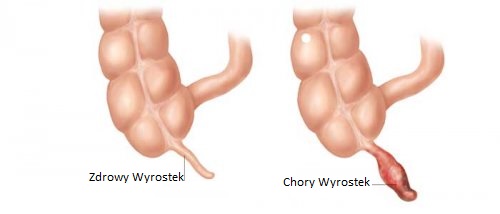 Wyrostek robaczkowy