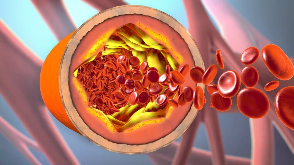 Złogi cholesterolu wewnątrz naczyń krwionośnych