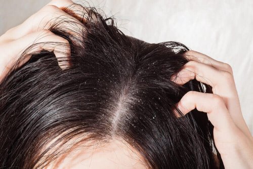 Grzybica skóry głowy – 6 domowych remediów