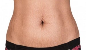 Naturalne sposoby na rozstępy – łatwe i skuteczne!