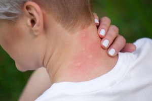 Reakcja alergiczna na ukąszenie owada - leczenie