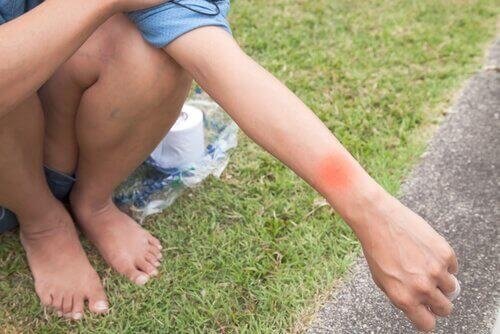 reakcja alergiczna na ukąszenie owada na ręce