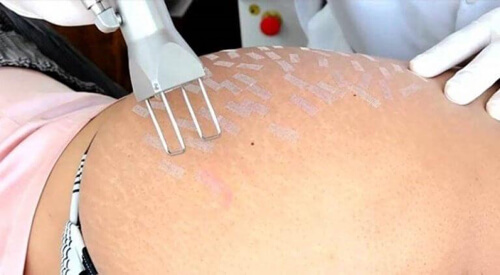 Rozstępy mogą spędzać Ci sen z powiek, ale można się ich pozbyć!