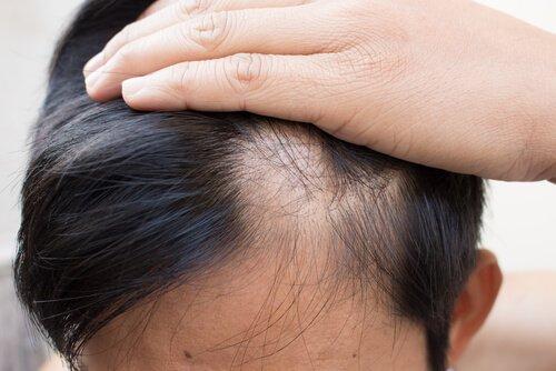 Łysienie plackowate często prowadzi do zaniku włosów nad czołem.