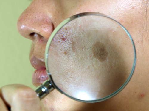Melanoderma.