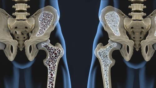 Zapobieganie osteoporozie za pomocą tych produktów